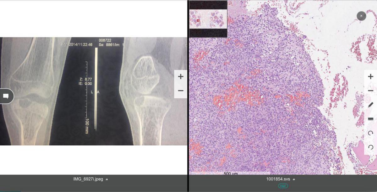 Случай 10. Мальчик, 15 лет. В течение 6 месяцев беспокоят периодически возникающие боли вокруг левого коленного сустава после незначительной травмы. Месяц назад присоединился легкий отек мягких тканей в этой же области. При обследовании было выявлено хорошо ограниченное образование левой большеберцовой кости. Выполнен кюретаж. Материал направлен на гистологическое исследование.