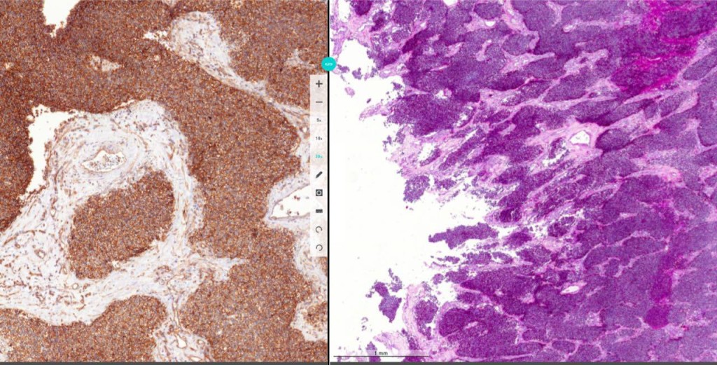 Случай 23. Пациент 19 лет с забрюшинной опухолью, выполнена инцизионная биопсия.